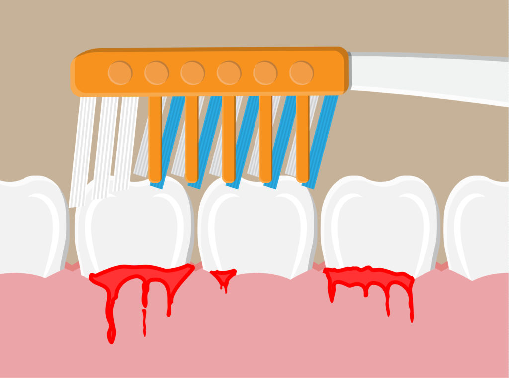 What Do Bleeding Gums Mean? Mountain View Pediatric Dentistry