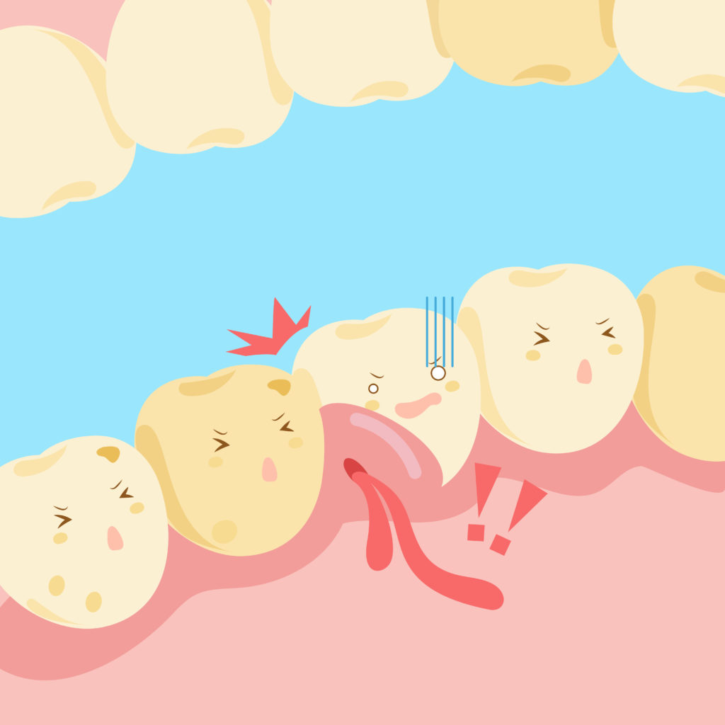 What do Bleeding Gums Mean? bleeding gums